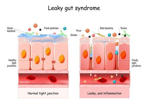 Leaky gut syndrome & IBS support